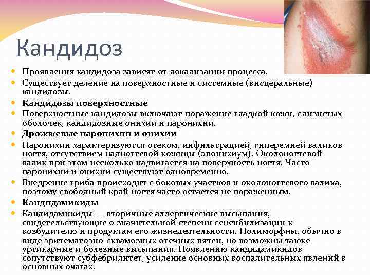 Кандидоз Проявления кандидоза зависят от локализации процесса. Существует деление на поверхностные и системные (висцеральные)