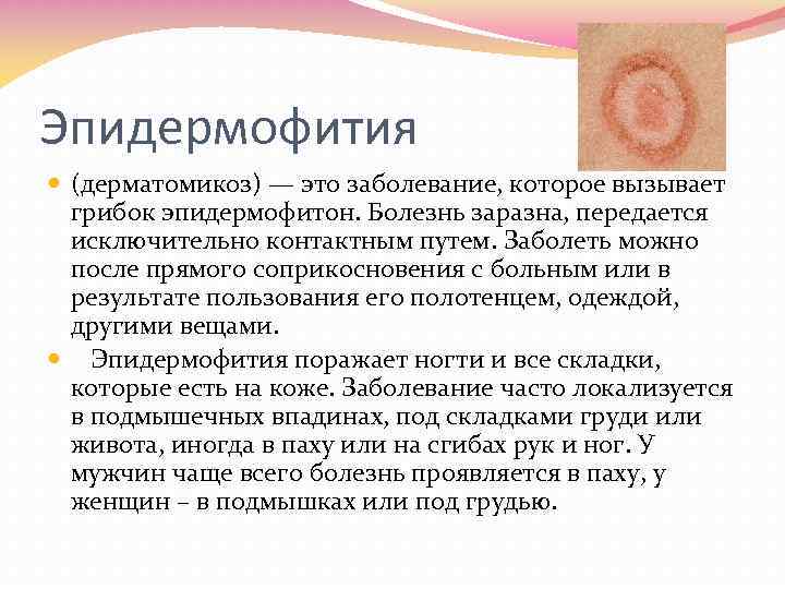 Эпидермофития (дерматомикоз) — это заболевание, которое вызывает грибок эпидермофитон. Болезнь заразна, передается исключительно контактным