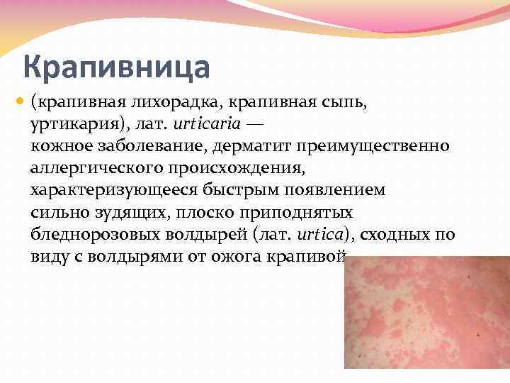 Крапивница (крапивная лихорадка, крапивная сыпь, уртикария), лат. urticaria — кожное заболевание, дерматит преимущественно аллергического