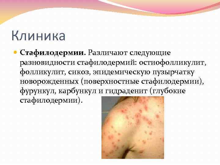 Клиника Стафилодермии. Различают следующие разновидности стафилодермий: остиофолликулит, сикоз, эпидемическую пузырчатку новорожденных (поверхностные стафилодермии), фурункул,