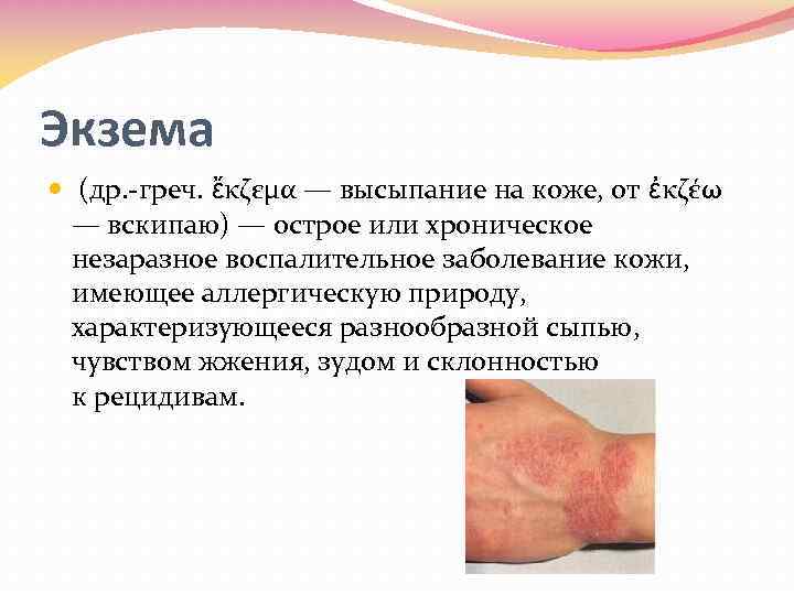 Экзема (др. греч. ἔκζεμα — высыпание на коже, от ἐκζέω — вскипаю) — острое