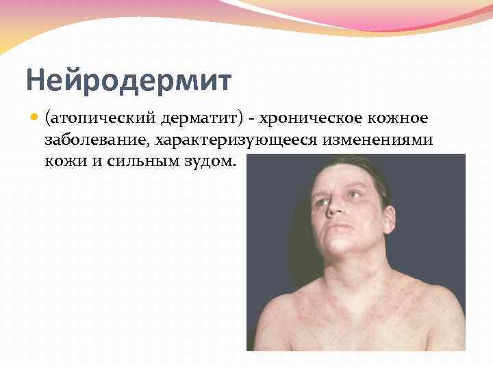 Нейродермит (атопический дерматит) хроническое кожное заболевание, характеризующееся изменениями кожи и сильным зудом. 