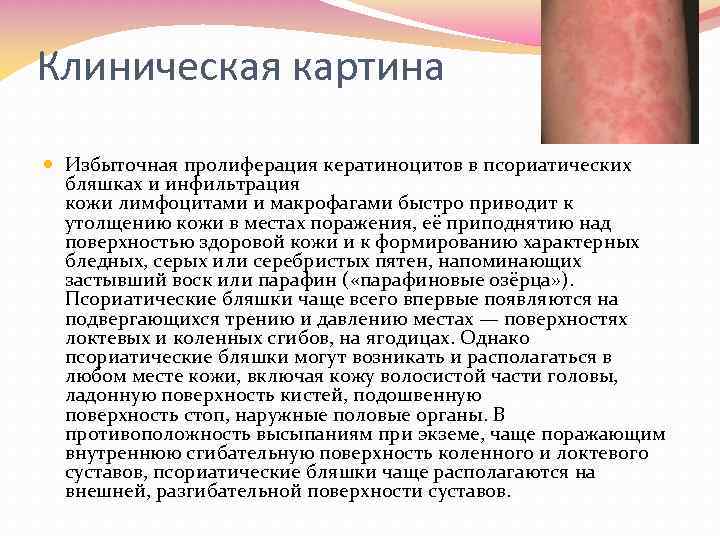 Клиническая картина Избыточная пролиферация кератиноцитов в псориатических бляшках и инфильтрация кожи лимфоцитами и макрофагами