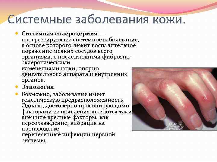 Системные заболевания кожи. Системная склеродермия — прогрессирующее системное заболевание, в основе которого лежит воспалительное