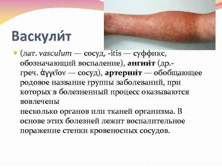 Васкули т (лат. vasculum — сосуд, itis — суффикс, обозначающий воспаление), ангии т (др.