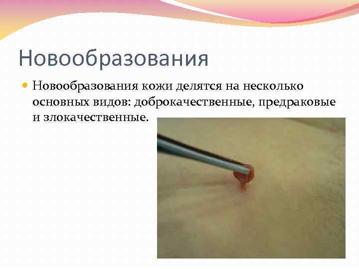 Новообразования кожи делятся на несколько основных видов: доброкачественные, предраковые и злокачественные. 