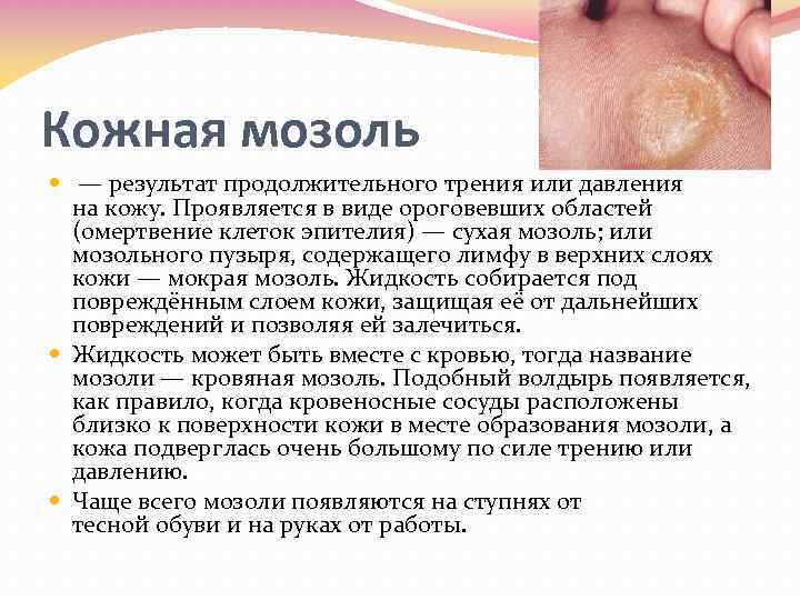 Кожная мозоль — результат продолжительного трения или давления на кожу. Проявляется в виде ороговевших