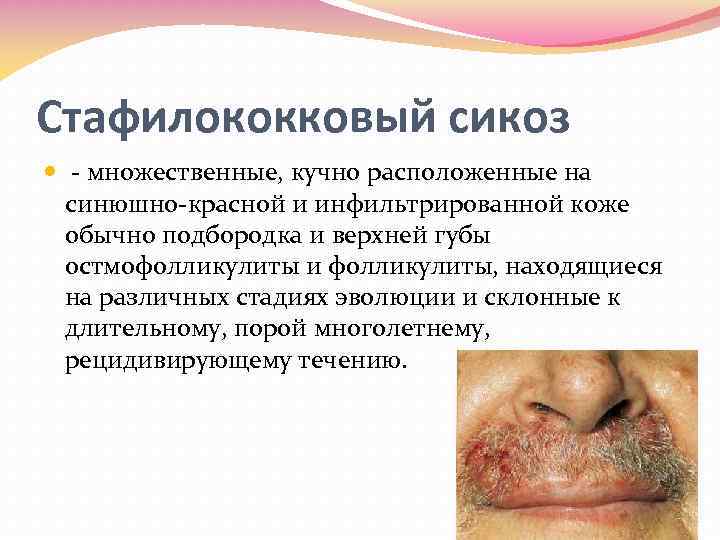Стафилококковый сикоз множественные, кучно расположенные на синюшно красной и инфильтрированной коже обычно подбородка и