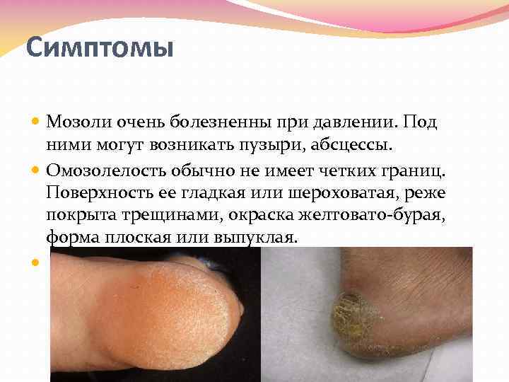 Симптомы Мозоли очень болезненны при давлении. Под ними могут возникать пузыри, абсцессы. Омозолелость обычно
