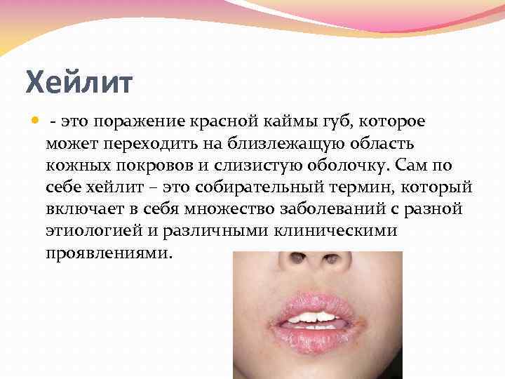 Хейлит это поражение красной каймы губ, которое может переходить на близлежащую область кожных покровов