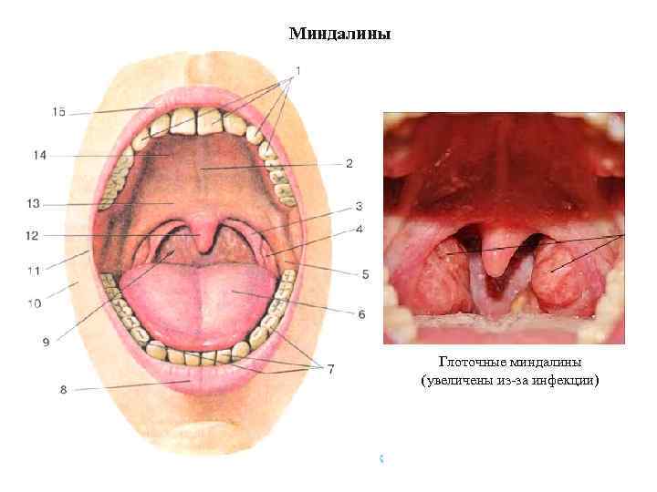 Миндалины Глоточные миндалины (увеличены из-за инфекции) 