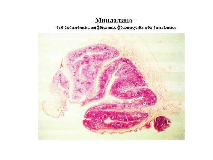 Миндалина это скопление лимфоидных фолликулов под эпителием 