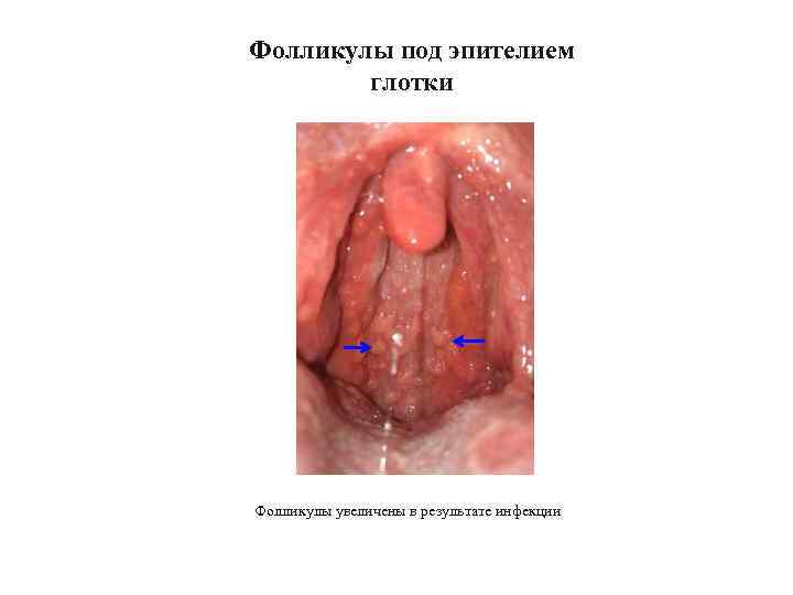 Фолликулы под эпителием глотки Фолликулы увеличены в результате инфекции 
