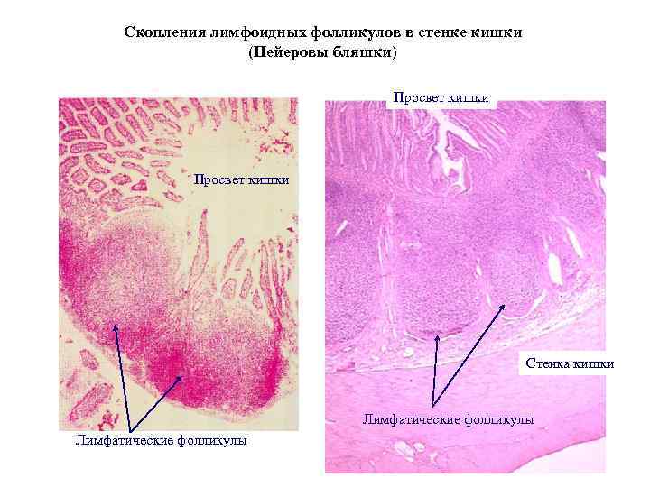 Скопления лимфоидных фолликулов в стенке кишки (Пейеровы бляшки) Просвет кишки Стенка кишки Лимфатические фолликулы