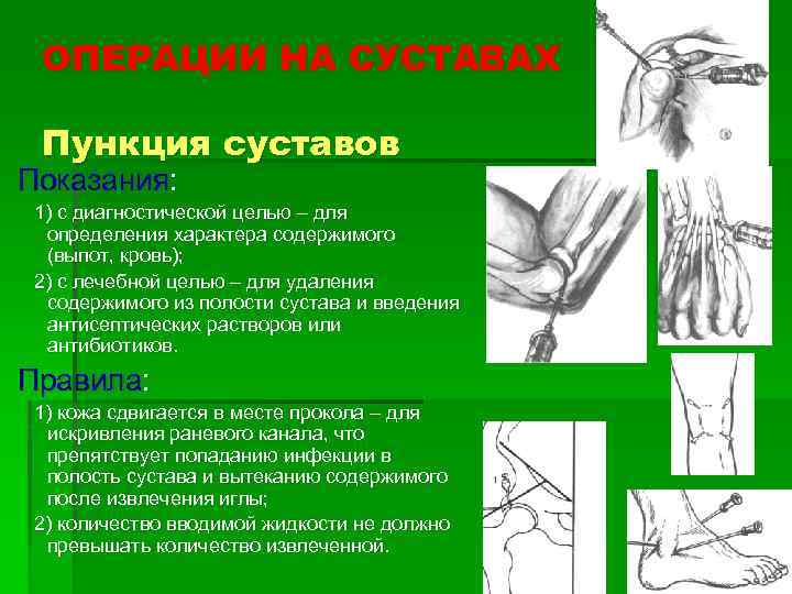 ОПЕРАЦИИ НА СУСТАВАХ Пункция суставов Показания: 1) с диагностической целью – для определения характера