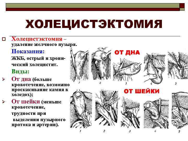 ХОЛЕЦИСТЭКТОМИЯ o Холецистэктомия – удаление желчного пузыря. Показания: ЖКБ, острый и хронический холецистит. Ø