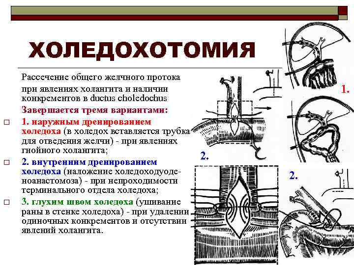 ХОЛЕДОХОТОМИЯ o o o Рассечение общего желчного протока при явлениях холангита и наличии конкрементов