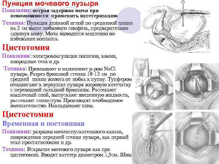 Острая задержка мочи карта вызова скорой