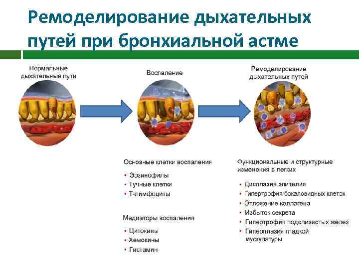 Ремоделирование дыхательных путей при бронхиальной астме 