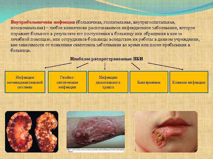 Внутрибольничная инфекция (больничная, госпитальная, внутригоспитальная, нозокомиальная) – любое клинически распознаваемое инфекционное заболевание, которое поражает