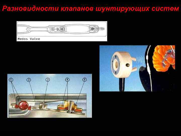 Разновидности клапанов шунтирующих систем 102 