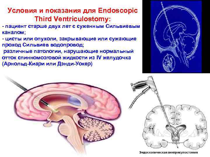 Условия и показания для Endoscopic Third Ventriculostomy: - пациент старше двух лет с суженным