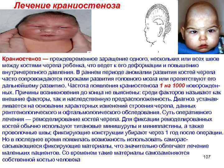 Лечение краниостеноза Краниостеноз — преждевременное заращение одного, нескольких или всех швов между костями черепа