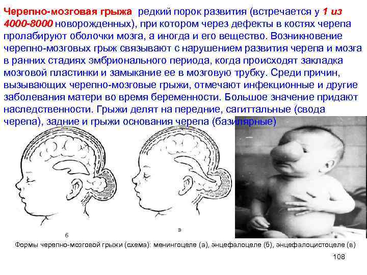 Черепно мозговая грыжа редкий порок развития (встречается у 1 из 4000 -8000 новорожденных), при