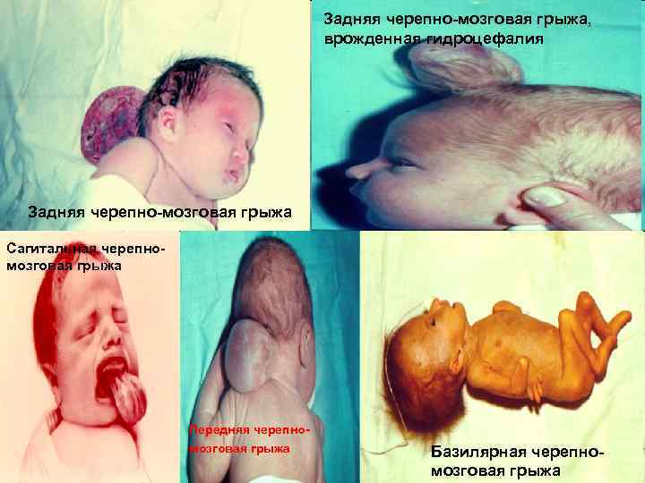 Задняя черепно мозговая грыжа, врожденная гидроцефалия Задняя черепно мозговая грыжа Сагитальная черепно мозговая грыжа