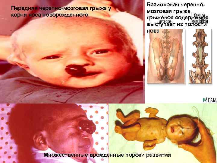 Передняя черепно мозговая грыжа у корня носа новорожденного Базилярная черепно мозговая грыжа, грыжевое содержимое