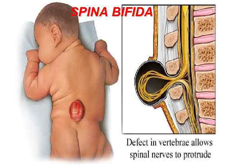 SPINA BIFIDA 111 