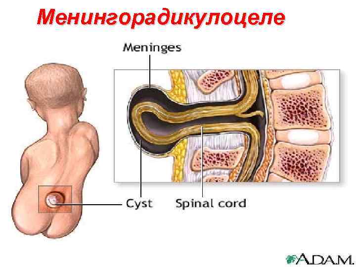 Менингорадикулоцеле 112 