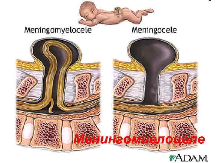 Менингомиелоцеле 113 