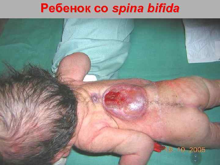 Ребенок со spina bifida 116 