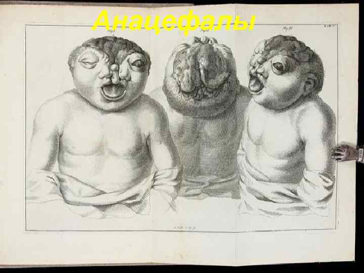 Анацефалы 129 
