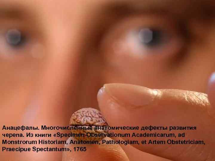 Анацефалы. Многочисленные анатомические дефекты развития черепа. Из книги «Specimen Observationum Academicarum, ad Monstrorum Historiam,