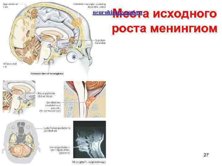 Места исходного роста менингиом neurohirurg. umi. ru 27 