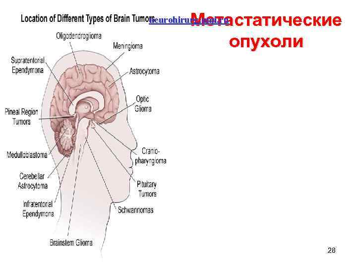 Метастатические опухоли neurohirurg. umi. ru 28 