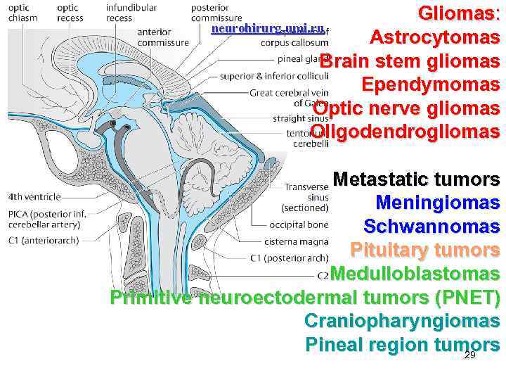 Gliomas: neurohirurg. umi. ru Astrocytomas Brain stem gliomas Ependymomas Optic nerve gliomas Oligodendrogliomas Metastatic