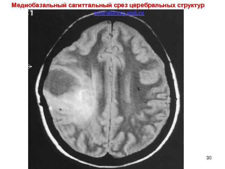 Церебральный сосудистый криз