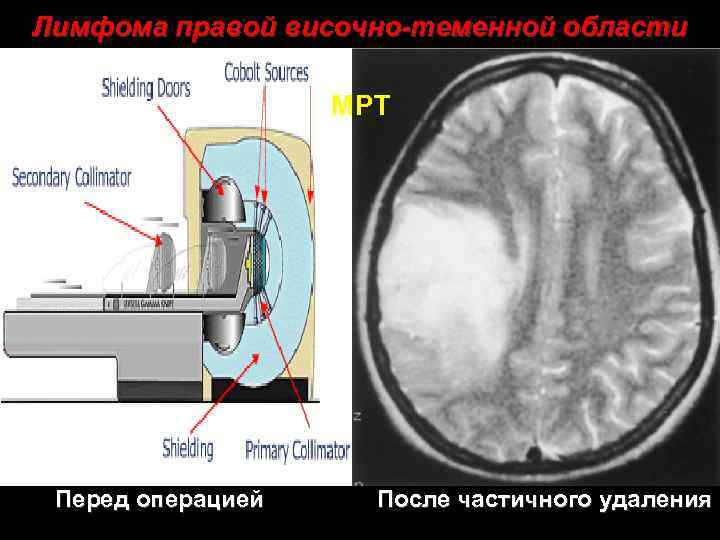 Лимфома правой височно-теменной области МРТ Перед операцией После частичного удаления 31 
