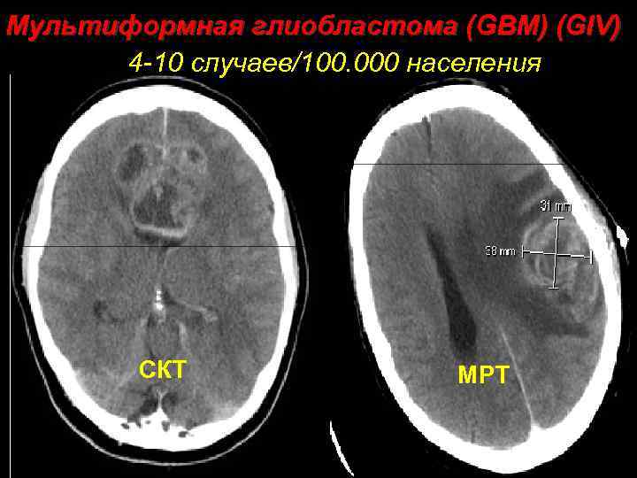Мультиформная глиобластома (GBM) (GIV) 4 -10 случаев/100. 000 населения СКТ МРТ 
