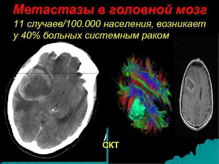 Метастазы в головной мозг 11 случаев/100. 000 населения, возникает у 40% больных системным раком