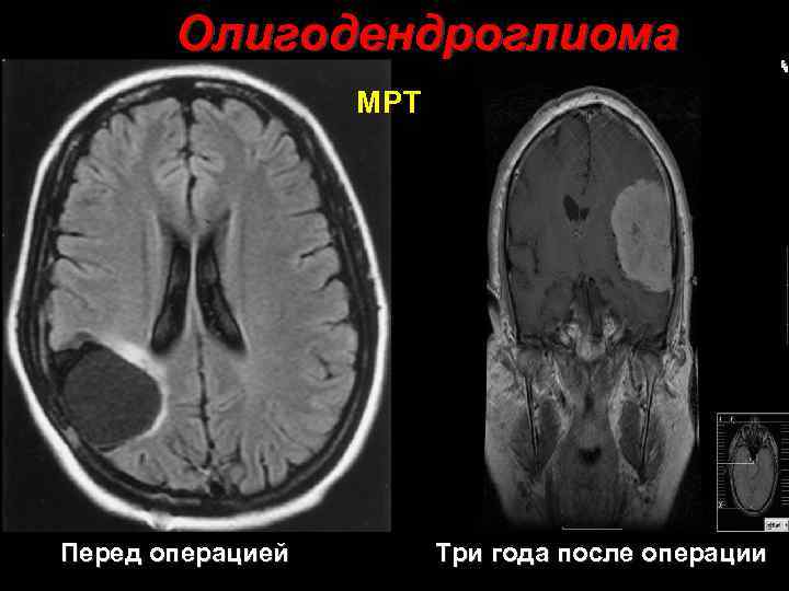 Олигодендроглиома МРТ Перед операцией 34 Три года после операции 