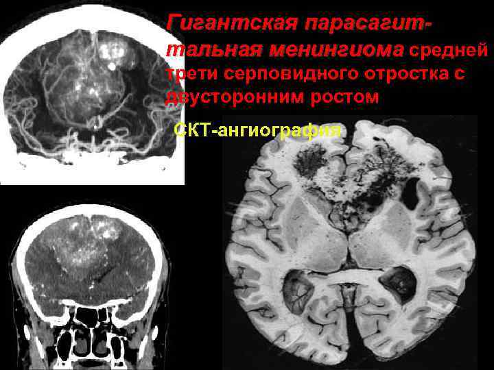 Гигантская парасагиттальная менингиома средней трети серповидного отростка с двусторонним ростом СКТ ангиография 36 