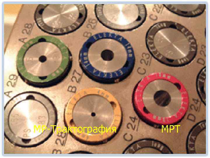 МР-Трактография МРТ 