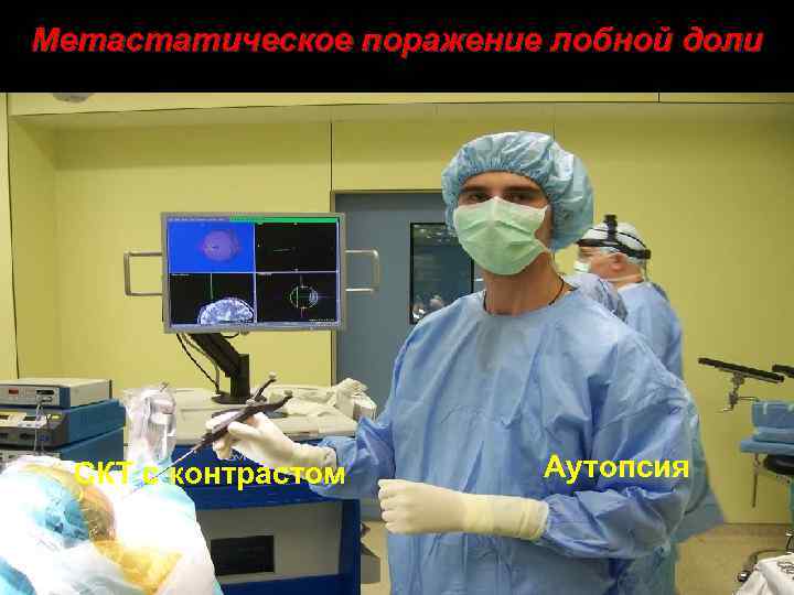 Метастатическое поражение лобной доли СКТ с контрастом Аутопсия 39 