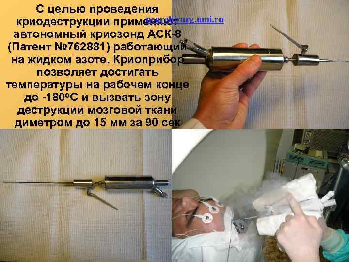 С целью проведения neurohirurg. umi. ru криодеструкции применяют автономный криозонд АСК 8 (Патент №