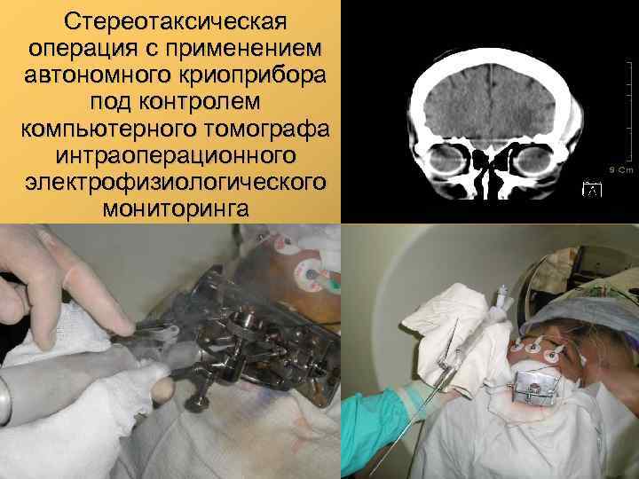 Стереотаксическая операция с применением автономного криоприбора под контролем компьютерного томографа интраоперационного электрофизиологического мониторинга 47