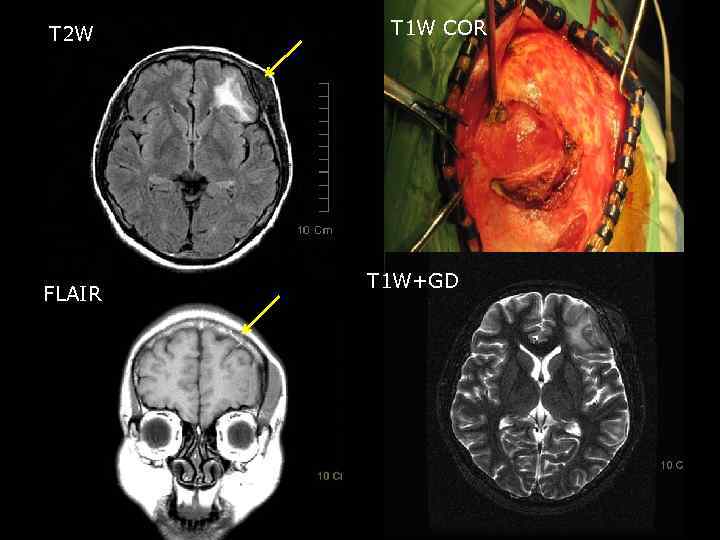 T 2 W FLAIR T 1 W COR T 1 W+GD 50 